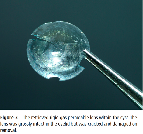 Illustration for article titled 28 Years After Woman 'Loses' Contact Lens, Surgeons Find It Embedded in Her Eyelid
